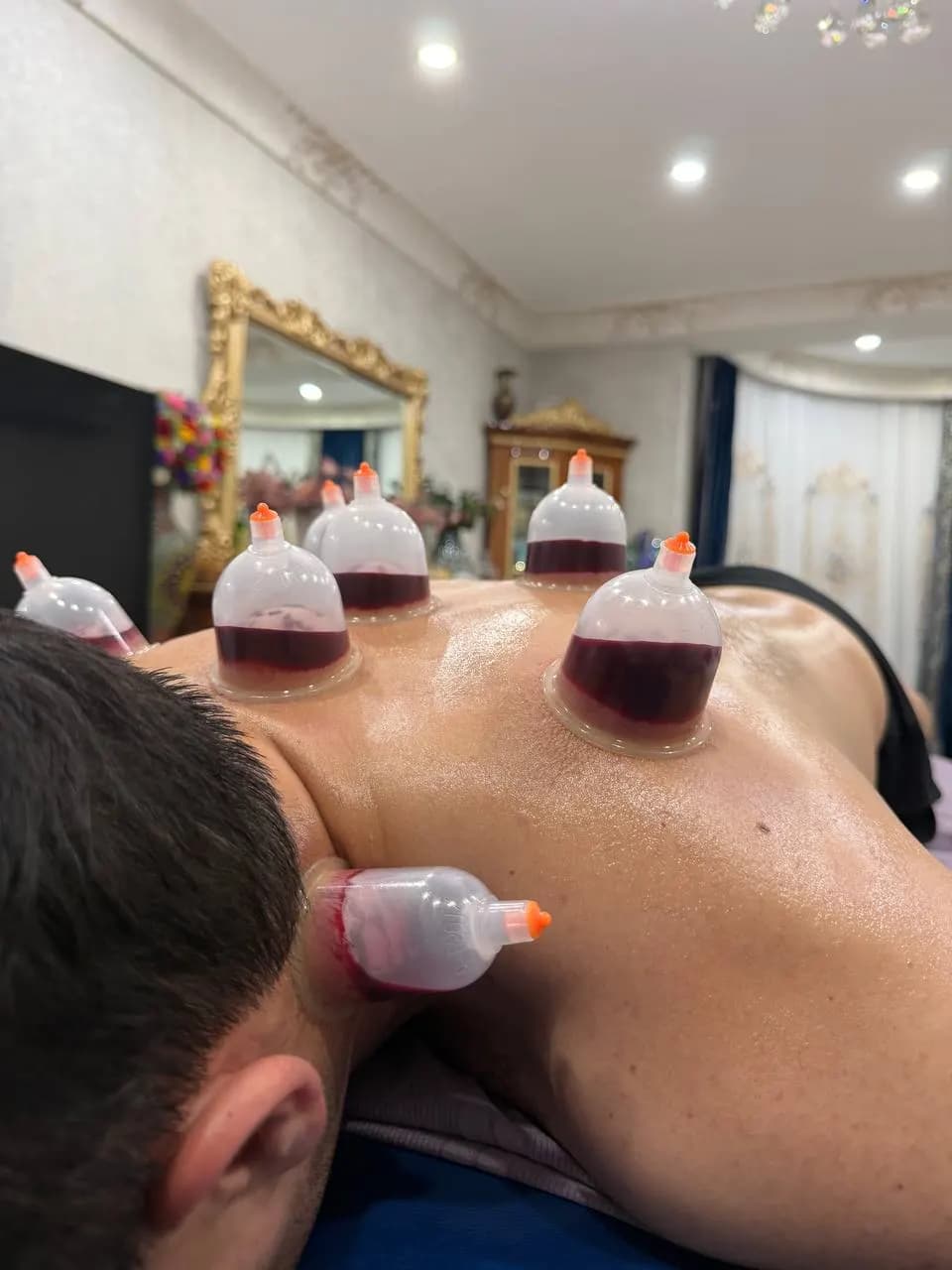 Cupping and Leech Service