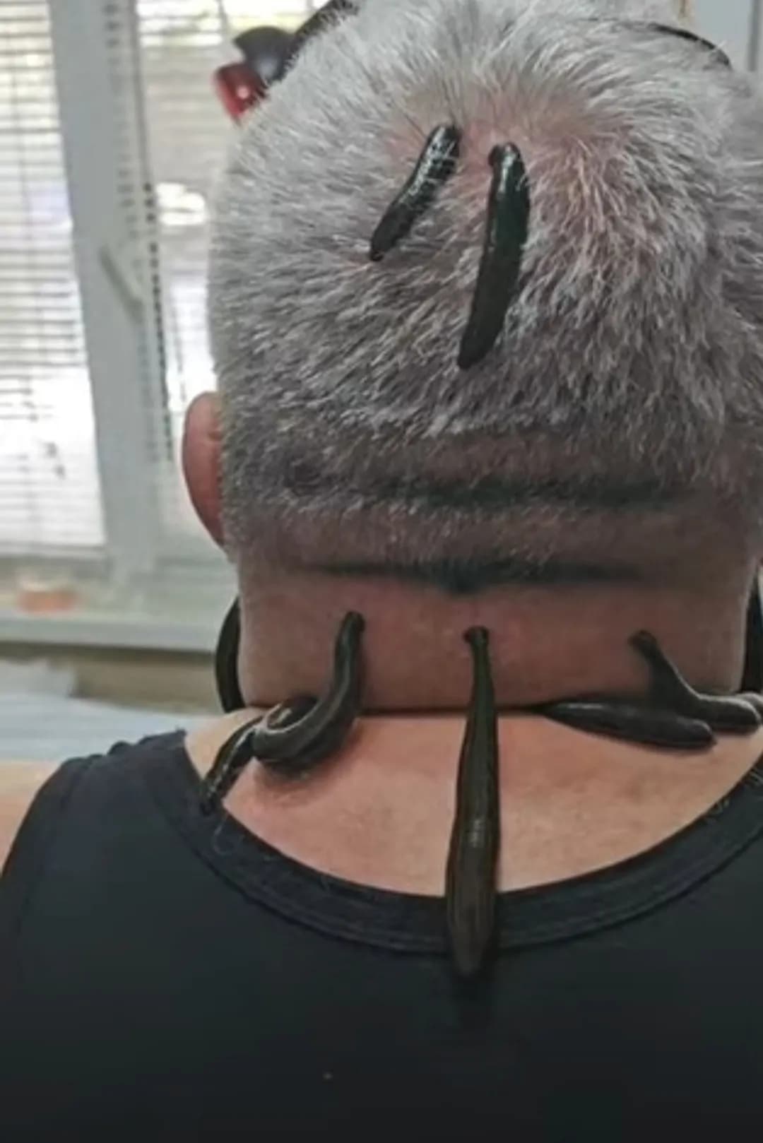 Cupping and Leech Service