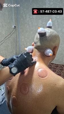 HIJAMA AND LEECH
